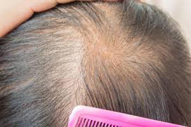 ریزش مو 2 تا 3 ماه بعد از بهبود شروع می گردد ، با ریزش کرونایی مو چه کنیم؟!