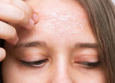 پوست دهیدراته چیست و چطور می توان آن را درمان کرد؟